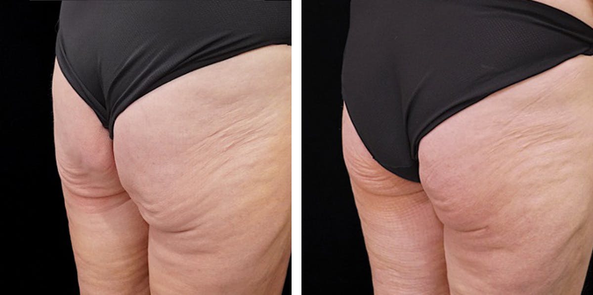 Alloclae-adipose Filler - Body Before & After Gallery - Patient 382835 - Image 2