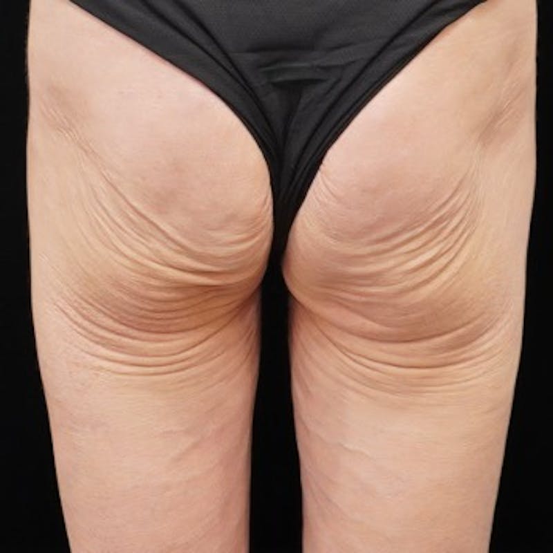 Alloclae-adipose Filler Before & After Gallery - Patient 320859 - Image 1