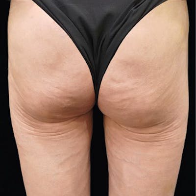 Alloclae-adipose Filler Before & After Gallery - Patient 320859 - Image 2