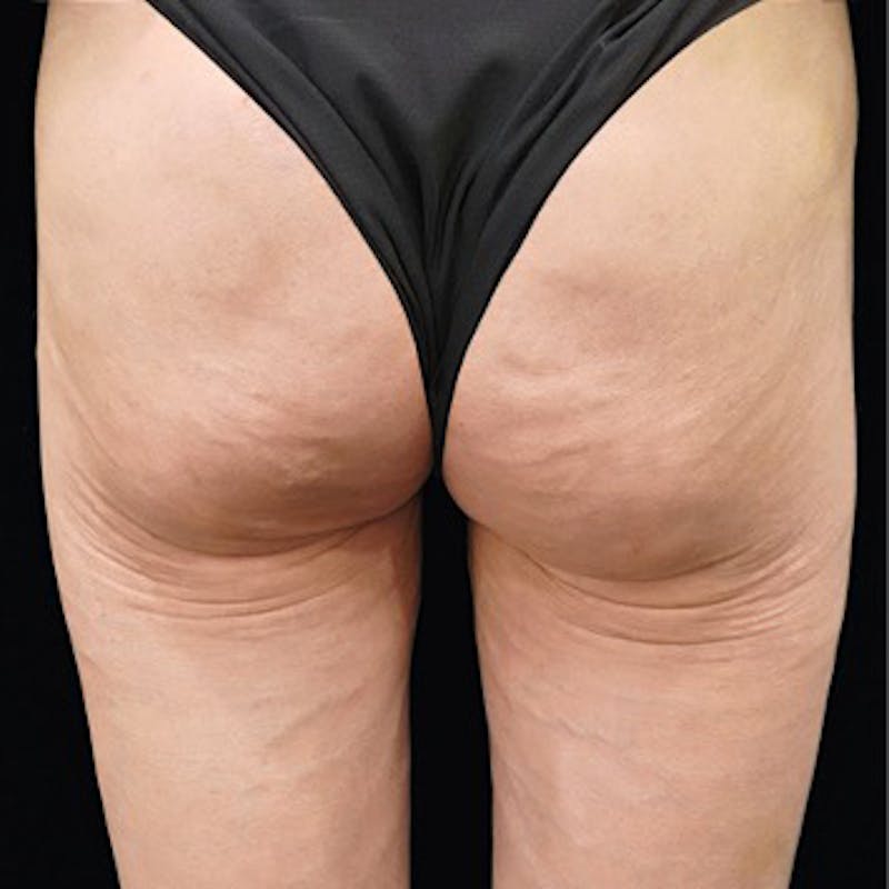 Alloclae-adipose Filler Before & After Gallery - Patient 320859 - Image 2