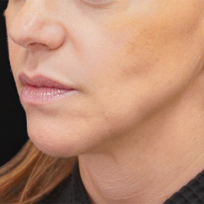 Alloclae-adipose Filler Before & After Gallery - Patient 419443 - Image 1