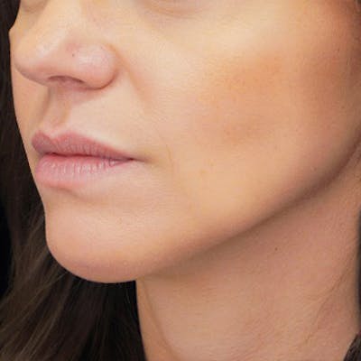 Alloclae-adipose Filler Before & After Gallery - Patient 419443 - Image 2