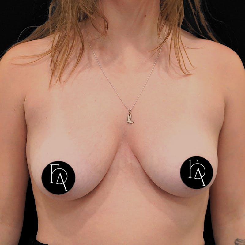 Breast Reduction Before & After Gallery - Patient 188832 - Image 1