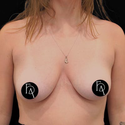 Areola Breast Reduction Surgery  Before & After Gallery - Patient 407402 - Image 1