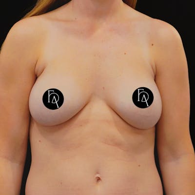 Breast Implant Exchange Before & After Gallery - Patient 306225 - Image 1
