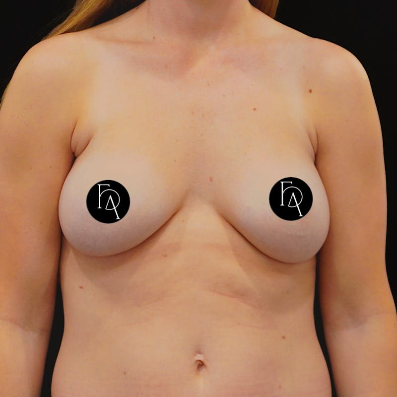 Breast Implant Exchange Before & After Gallery - Patient 306225 - Image 1