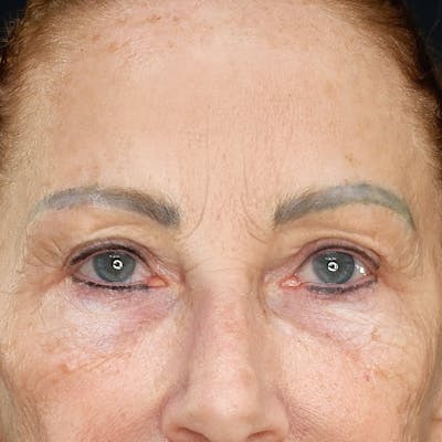 Brow Lift Before & After Gallery - Patient 160322 - Image 1