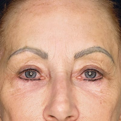 Brow Lift Before & After Gallery - Patient 160322 - Image 2