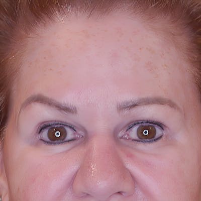 Brow Lift Before & After Gallery - Patient 830924 - Image 1