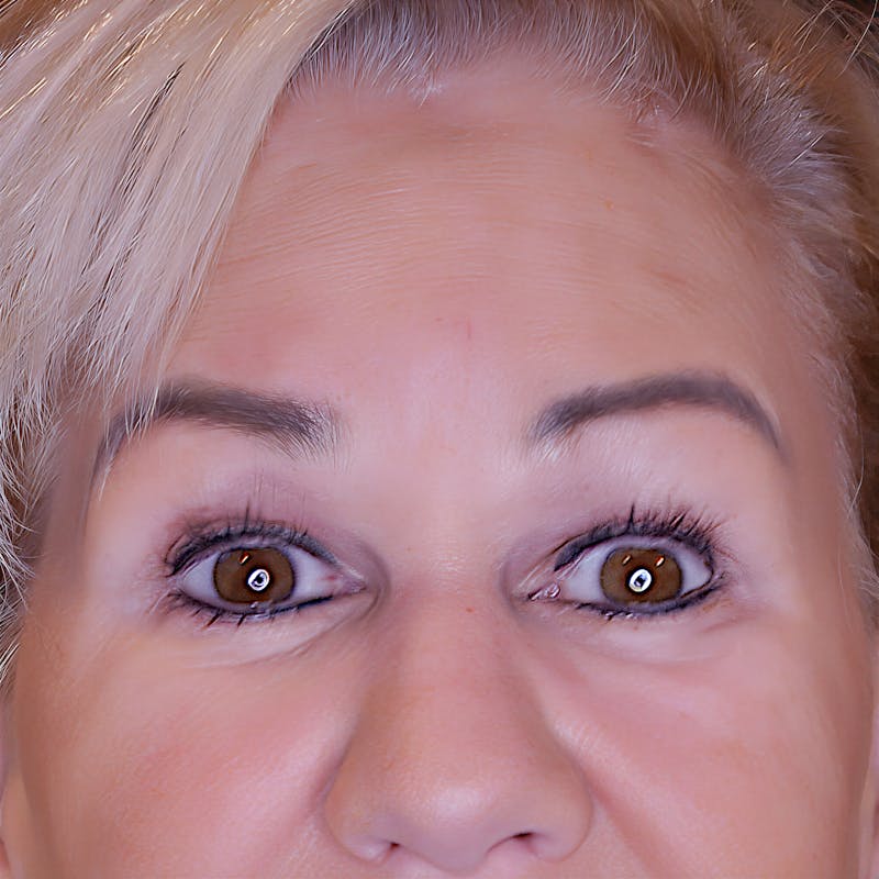 Brow Lift Before & After Gallery - Patient 830924 - Image 2