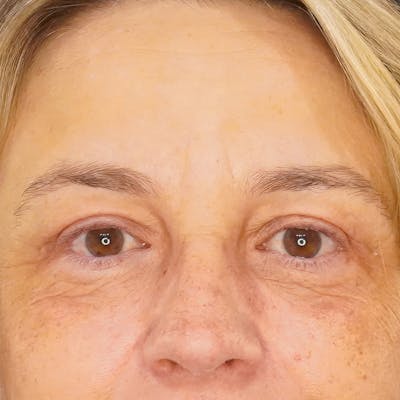 Brow Lift Before & After Gallery - Patient 384538 - Image 1