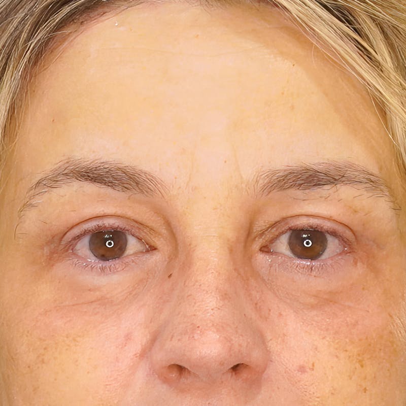 Brow Lift Before & After Gallery - Patient 384538 - Image 2