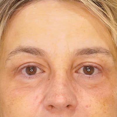 Brow Lift Before & After Gallery - Patient 384538 - Image 2