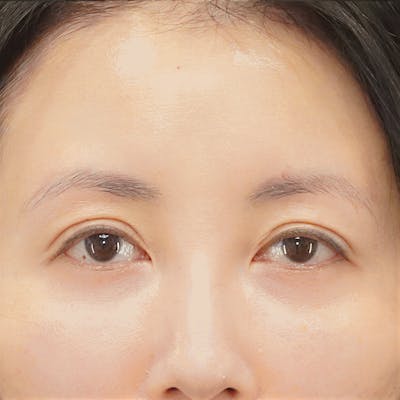 Brow Lift Before & After Gallery - Patient 231632 - Image 2