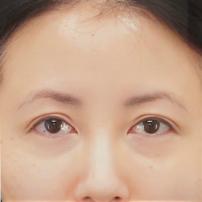 Brow Lift Before & After Gallery - Patient 231632 - Image 1