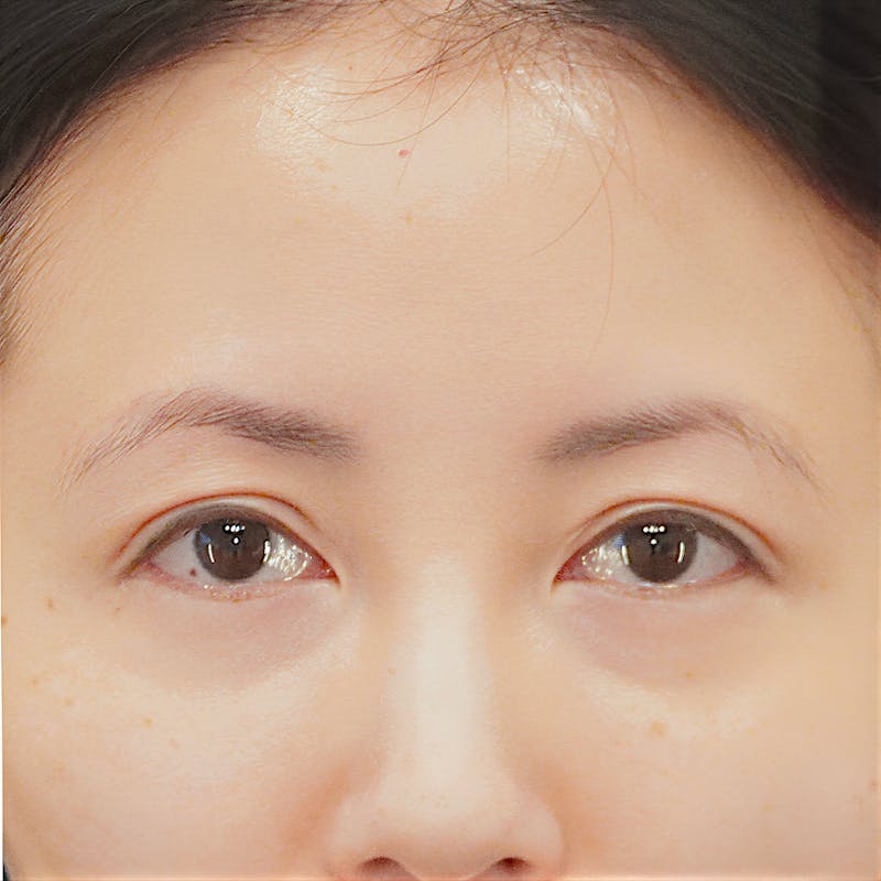 Brow Lift Before & After Gallery - Patient 231632 - Image 1