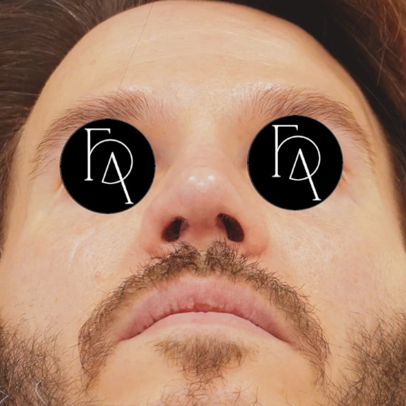Rhinoplasty Before & After Gallery - Patient 768312 - Image 4