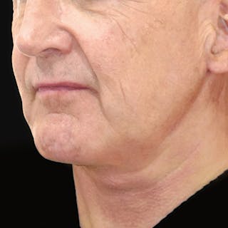 Deep Plane Facelift Before & After Gallery - Patient 437588 - Image 2