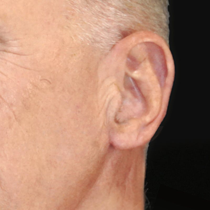 Deep Plane Facelift Before & After Gallery - Patient 437588 - Image 4