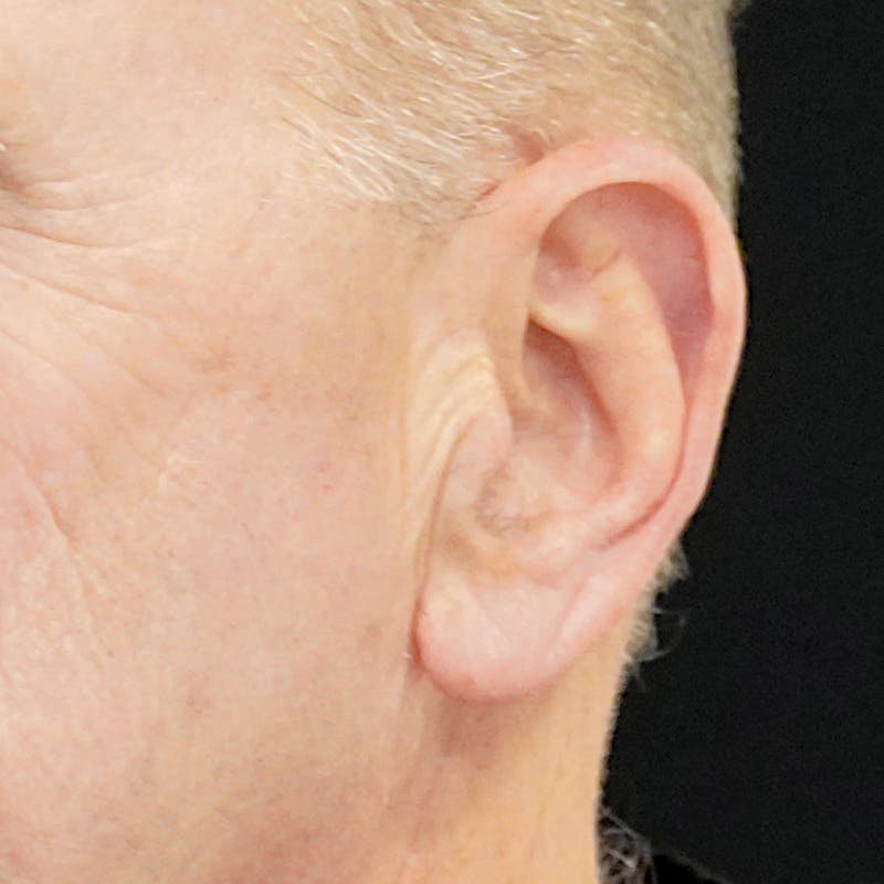Deep Plane Facelift Before & After Gallery - Patient 437588 - Image 3