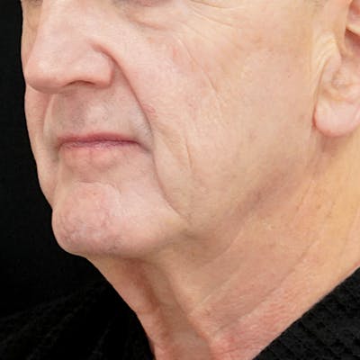 Deep Plane Facelift Before & After Gallery - Patient 437588 - Image 1