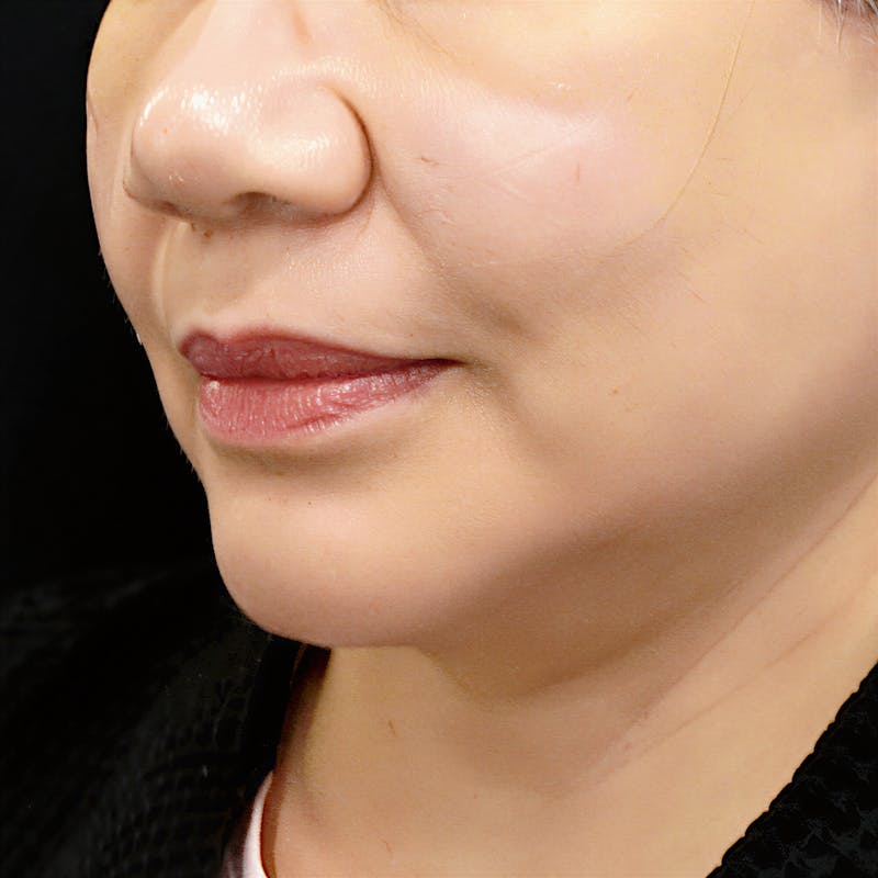 Deep Plane Facelift Before & After Gallery - Patient 165734 - Image 2