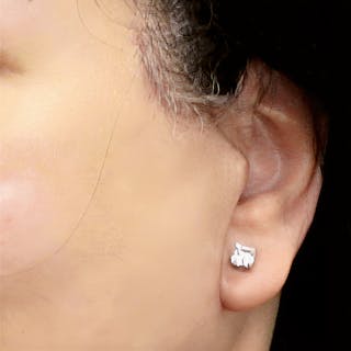 Deep Plane Facelift Before & After Gallery - Patient 165734 - Image 4