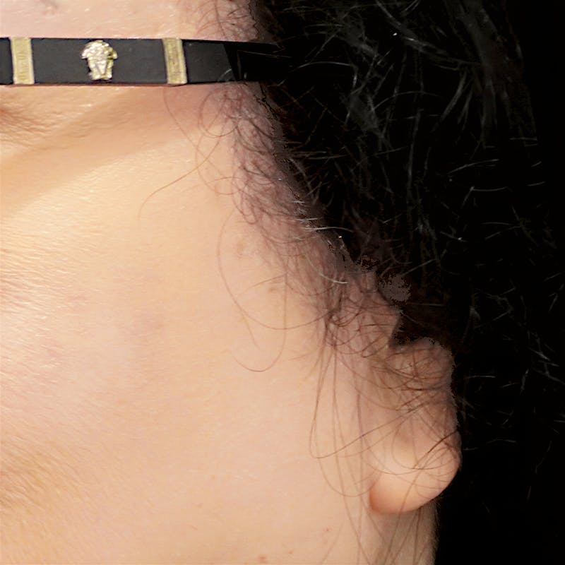 Deep Plane Facelift Before & After Gallery - Patient 165734 - Image 3