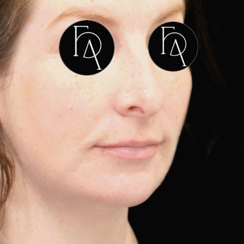 Chin Augmentation Before & After Gallery - Patient 219844 - Image 2