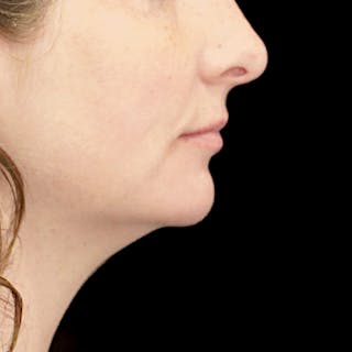 Chin Augmentation Before & After Gallery - Patient 219844 - Image 4