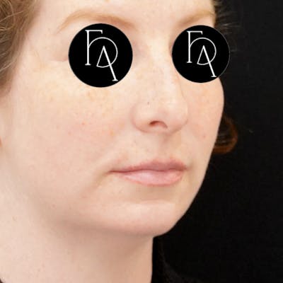 Chin Augmentation Before & After Gallery - Patient 219844 - Image 1