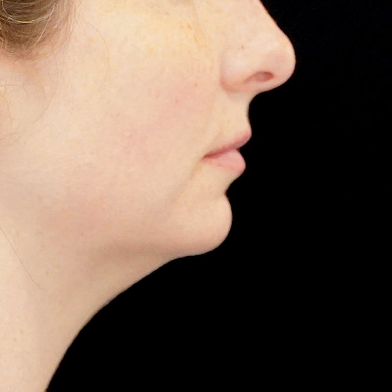 Chin Augmentation Before & After Gallery - Patient 219844 - Image 3