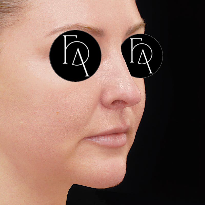 Chin Augmentation Before & After Gallery - Patient 230066 - Image 2