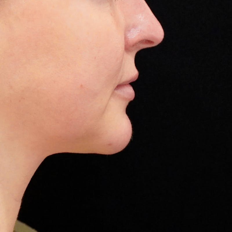 Chin Augmentation Before & After Gallery - Patient 230066 - Image 4