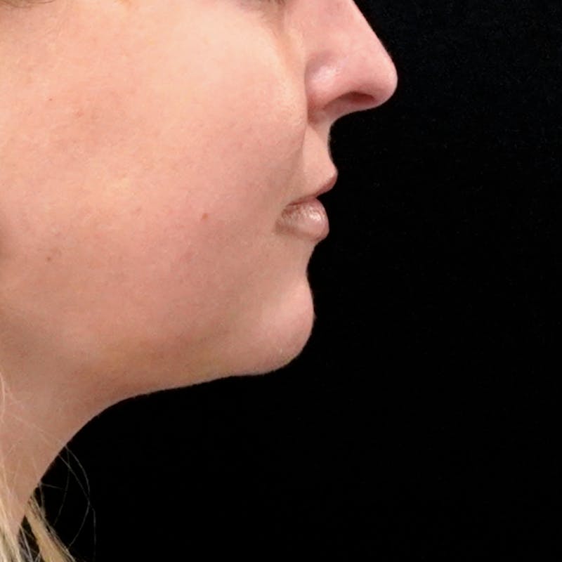 Chin Augmentation Before & After Gallery - Patient 230066 - Image 3