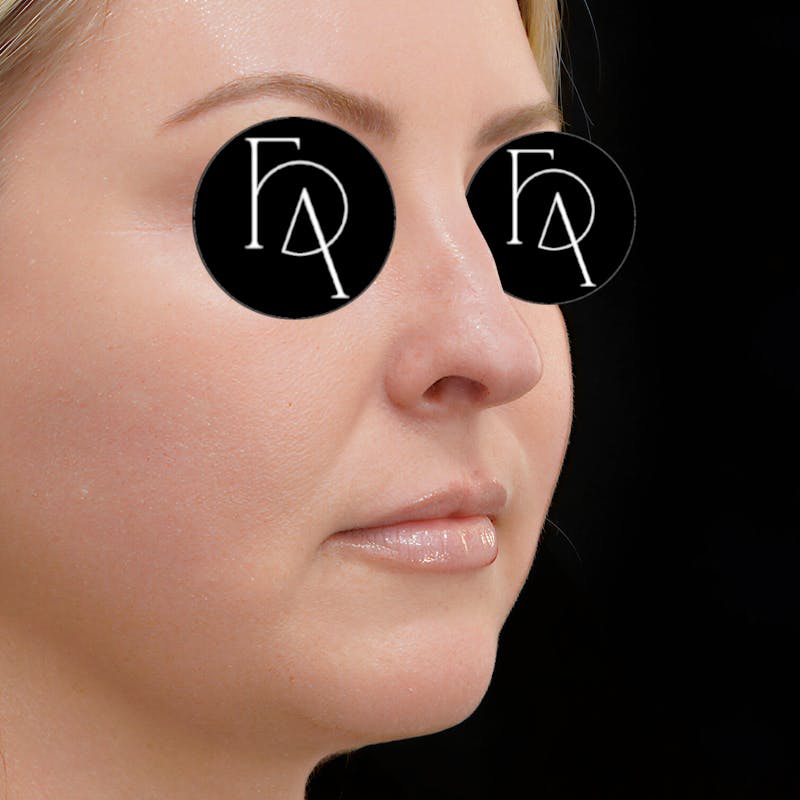 Chin Augmentation Before & After Gallery - Patient 230066 - Image 1