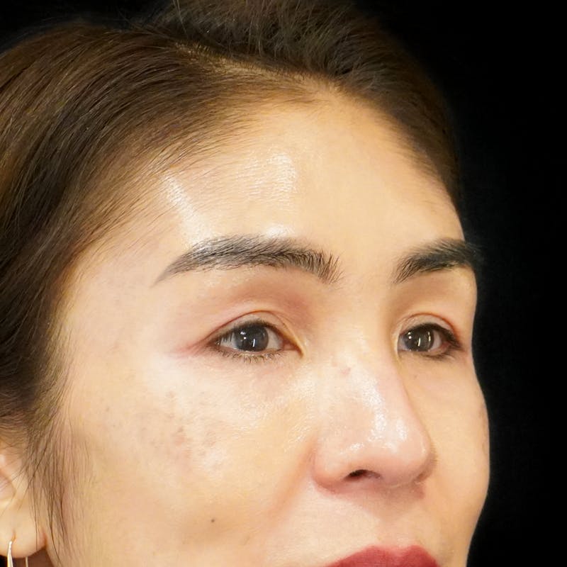 Upper Blepharoplasty Before & After Gallery - Patient 273097 - Image 3