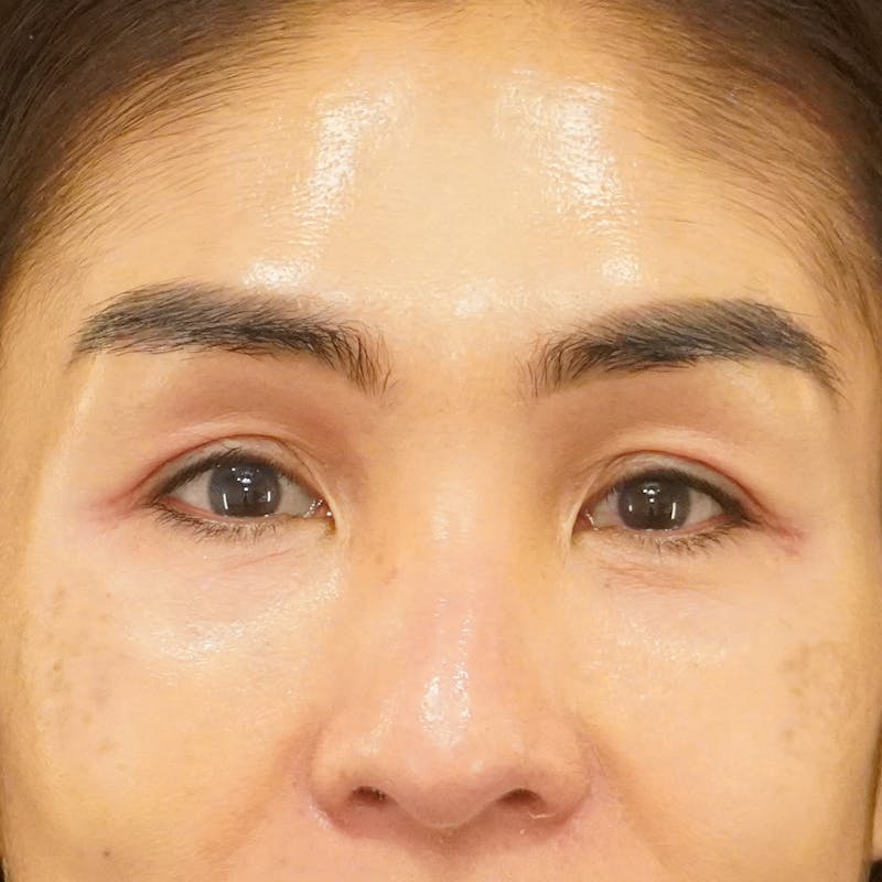 Upper Blepharoplasty Before & After Gallery - Patient 273097 - Image 1