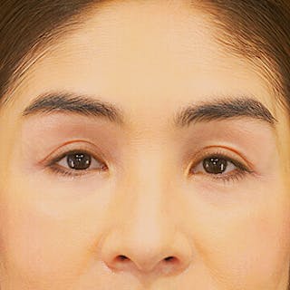 Upper Blepharoplasty Before & After Gallery - Patient 273097 - Image 2