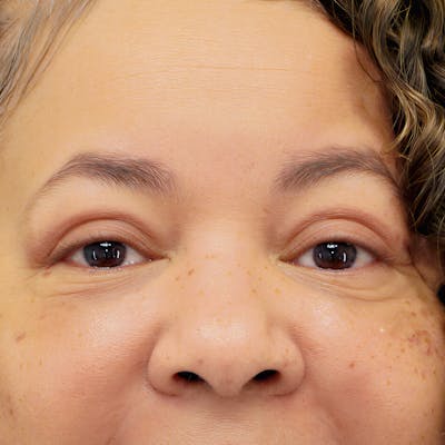 Upper Blepharoplasty Before & After Gallery - Patient 218314 - Image 2