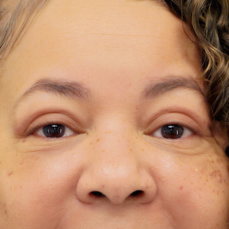 Upper Blepharoplasty Before & After Gallery - Patient 218314 - Image 2