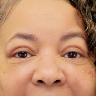 Upper Blepharoplasty Before & After Gallery - Patient 218314 - Image 2