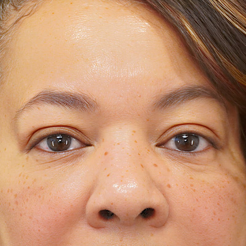 Upper Blepharoplasty Before & After Gallery - Patient 218314 - Image 1