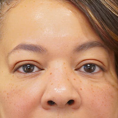 Upper Blepharoplasty Before & After Gallery - Patient 218314 - Image 1