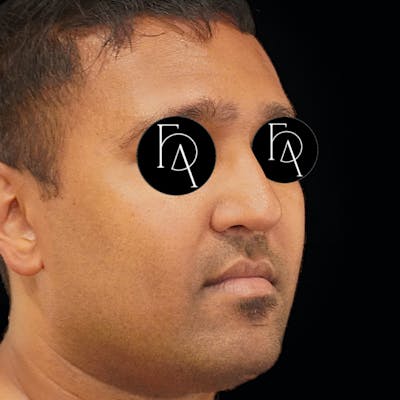 Rhinoplasty Before & After Gallery - Patient 271595 - Image 2