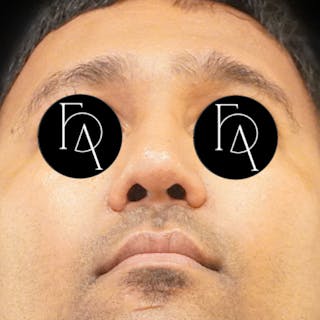 Rhinoplasty Before & After Gallery - Patient 271595 - Image 4