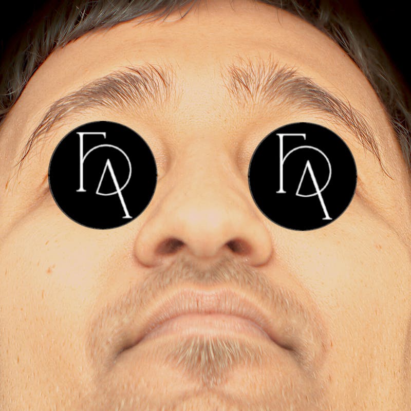 Rhinoplasty Before & After Gallery - Patient 271595 - Image 3