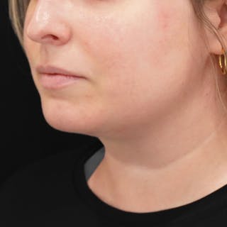 Platysmaplasty Before & After Gallery - Patient 204180 - Image 2