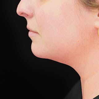Platysmaplasty Before & After Gallery - Patient 204180 - Image 4