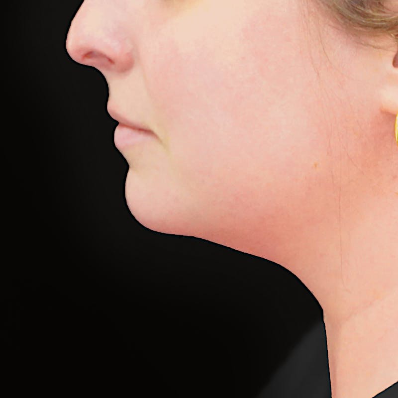 Platysmaplasty Before & After Gallery - Patient 204180 - Image 4